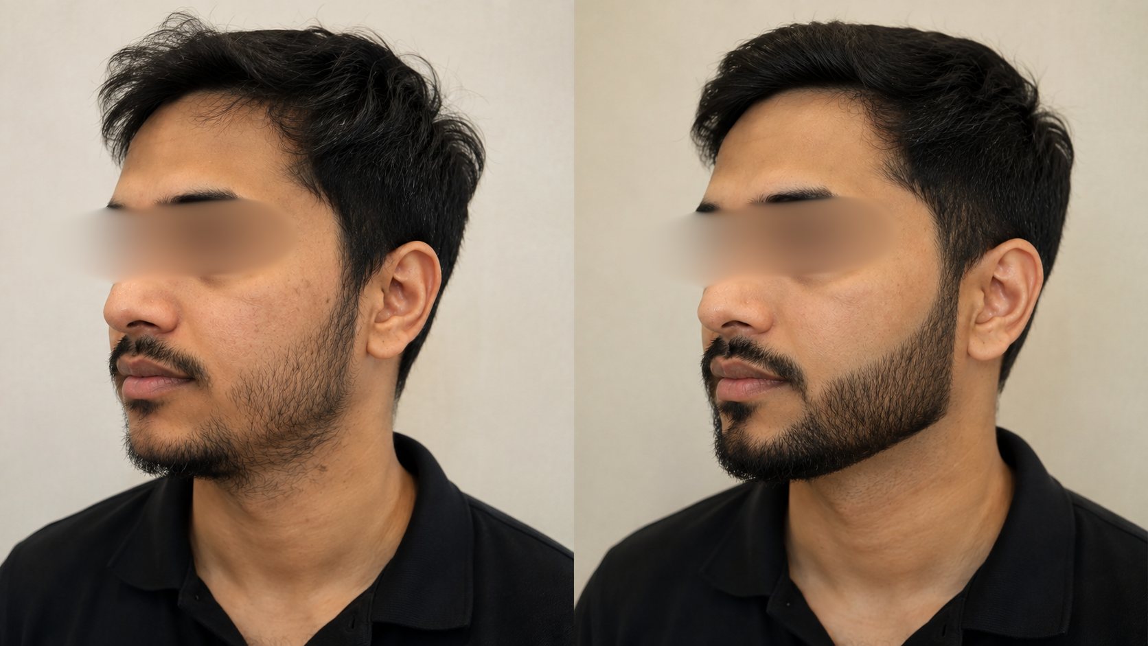 Beard Density & Shape